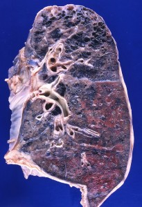 Lung with emphysema, caused by smoking Photo credit: Yale Rosen